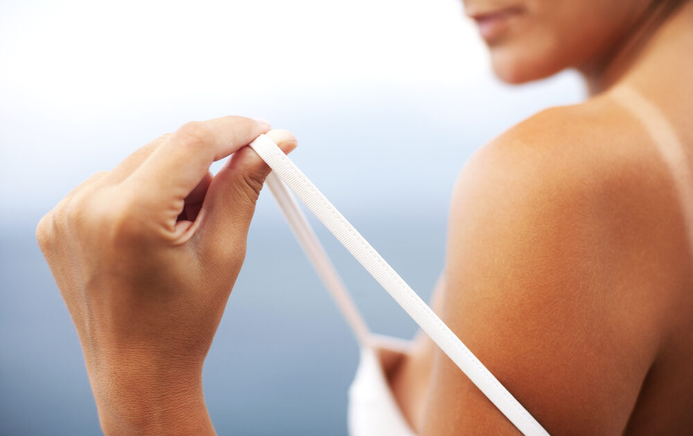 5 Natural Home Remedies for Sunburn Relief